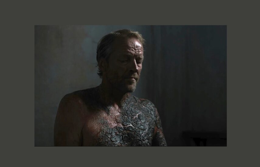Jorah, with his Greyscale spreading further