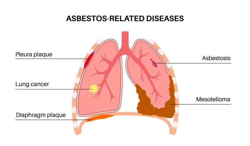 Asbestos Health Effects